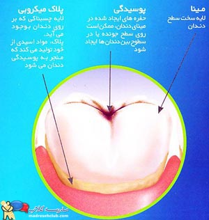 پوسیدگی دندان