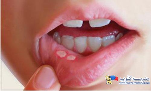 چه عواملی باعث ایجاد آفت در دهان میشود؟