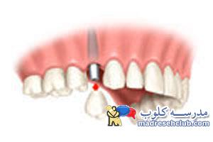 استفاده از ایمپلنت به عنوان جایگزین یک دندان