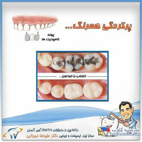 مواد همرنگ دندان چیست؟