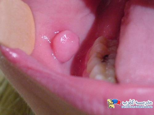 ضایعات و تومورهای خوش خیم حفره دهان