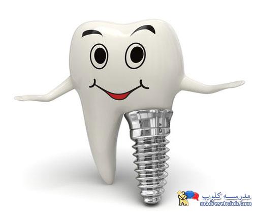 چه افرادی میتوانند ایمپلنت دندان بگذارند؟